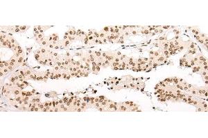 Immunohistochemistry of paraffin-embedded Human liver cancer tissue using VPS51 Polyclonal Antibody at dilution of 1:65(x200) (VPS51 Antikörper)