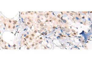 Immunohistochemistry of paraffin-embedded Human breast cancer tissue using VPS51 Polyclonal Antibody at dilution of 1:65(x200) (VPS51 Antikörper)