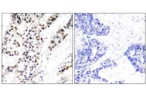Immunohistochemical analysis of paraffin- embedded human breast carcinoma tissue using Estrogen Receptor-α (phospho-Ser106) antibody (E011071). (Estrogen Receptor alpha Antikörper  (pSer106))