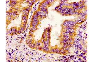 IHC image of ABIN7169929 diluted at 1:300 and staining in paraffin-embedded human endometrial cancer performed on a Leica BondTM system. (SCN9A Antikörper  (AA 1849-1988))
