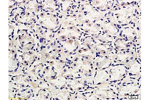 Formalin-fixed and paraffin embedded human gastric adenocarcinoma labeled with Rabbit Anti-CD45/B220 Polyclonal Antibody, Unconjugated (ABIN669606) at 1:200 followed by conjugation to the secondary antibody and DAB staining. (CD45 Antikörper  (AA 1210-1304))