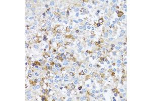Immunohistochemistry of paraffin-embedded human lung cancer using ACTR2 antibody. (ACTR2 Antikörper)