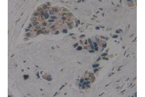 IHC-P analysis of Human Breast Cancer Tissue, with DAB staining. (Cytokeratin 1 Antikörper  (AA 487-644))