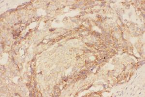 Anti-Eotaxin 3 Picoband antibody,  IHC(P): Human Mammary Cancer Tissue