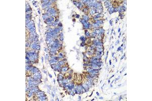 Immunohistochemistry of paraffin-embedded human colon carcinoma using RALB antibody at dilution of 1:100 (x40 lens).