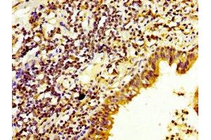 IHC image of ABIN7150781 diluted at 1:200 and staining in paraffin-embedded human lung cancer performed on a Leica BondTM system. (DUSP6 Antikörper  (AA 100-206))