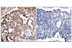 Immunohistochemical analysis of paraffin- embedded human breast carcinoma tissue, using SEK1/MKK4 (Ab-80) antibody (E021132). (MAP2K4 Antikörper)