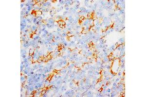 Anti-MPO antibody, IHC(P): Human Liver Cancer Tissue