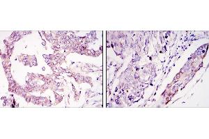 Immunohistochemical analysis of paraffin-embedded ovary tumour tissues (left) and lung cancer (right) using WIF1 mouse mAb with DAB staining. (WIF1 Antikörper)