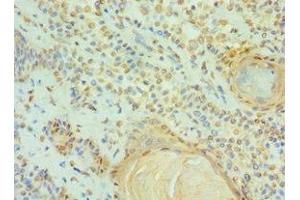 Immunohistochemistry of paraffin-embedded human breast cancer using ABIN7147295 at dilution of 1:100 (CCAR1 Antikörper  (AA 1-200))