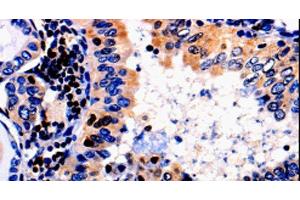 Immunohistochemistry of paraffin-embedded Human thyroid cancer tissue using ALOX5 Polyclonal Antibody at dilution 1:50 (ALOX5 Antikörper)
