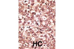 Formalin-fixed and paraffin-embedded human hepatocellular carcinoma tissue reacted with TLR6 polyclonal antibody  , which was peroxidase-conjugated to the secondary antibody, followed by AEC staining. (TLR6 Antikörper  (C-Term))
