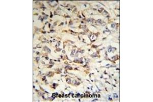 CPN2 Antibody (N-term) (R) IHC analysis in formalin fixed and paraffin embedded human breast carcinoma tissue followed by peroxidase conjugation of the secondary antibody and DAB staining. (CPN2 Antikörper  (N-Term))