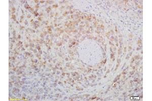 Formalin-fixed and paraffin embedded mouse lymphoma labeled with Rabbit Anti CD272/BTLA Polyclonal Antibody, Unconjugated (ABIN671031) at 1:200 followed by conjugation to the secondary antibody and DAB staining (BTLA Antikörper  (AA 221-289))