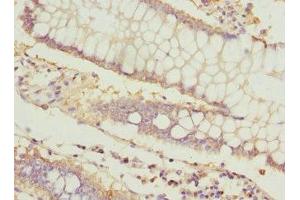 Immunohistochemistry of paraffin-embedded human colon cancer using ABIN7156542 at dilution of 1:100 (ICAM4 Antikörper  (AA 20-140))