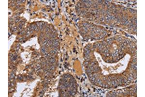 The image on the left is immunohistochemistry of paraffin-embedded Human colon cancer tissue using ABIN7130361(NDUFA1 Antibody) at dilution 1/70, on the right is treated with fusion protein.