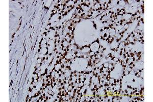 Immunoperoxidase of monoclonal antibody to NPM1 on formalin-fixed paraffin-embedded human ovary, clear cell carcinoma tissue.