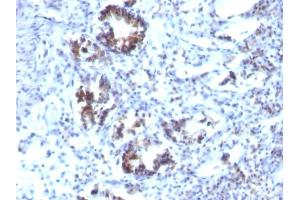 Formalin-fixed, paraffin-embedded human Colon Carcinoma stained with Transgelin Monoclonal Antibody (SPM606) (Transgelin Antikörper)