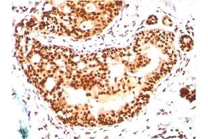 Formalin-fixed, paraffin-embedded human Breast Carcinoma stained with SUMO-2/3 Mouse Monoclonal Antibody (SM23/496) (SUMO2 Antikörper)