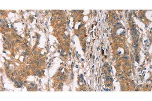Immunohistochemistry of paraffin-embedded Human gastric cancer using PLIN2 Polyclonal Antibody at dilution of 1:30 (ADRP Antikörper)