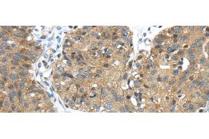Immunohistochemistry of paraffin-embedded Human breast cancer tissue using TMPRSS11E Polyclonal Antibody at dilution 1:45 (TMPRSS11E Antikörper)
