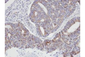 IHC-P Image Immunohistochemical analysis of paraffin-embedded human endo mitral ovarian cancer, using ARPC3, antibody at 1:100 dilution.