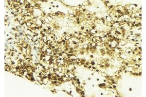ABIN6269162 at 1/100 staining Human breast cancer tissue by IHC-P.