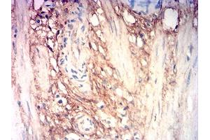 Immunohistochemical analysis of paraffin-embedded stomach cancer tissues using COL3A1 mouse mAb with DAB staining. (COL3A1 Antikörper  (AA 24-153))