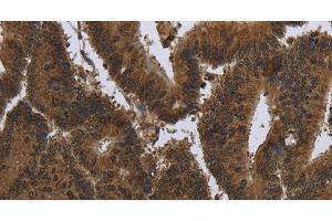 Immunohistochemistry of paraffin-embedded Human colon cancer tissue using PIP Polyclonal Antibody at dilution 1:50 (PIP Antikörper)
