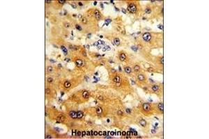 Formalin-fixed and paraffin-embedded human hepatocarcinoma reacted with RPS15 Antibody (N-term), which was peroxidase-conjugated to the secondary antibody, followed by DAB staining. (RPS15 Antikörper  (N-Term))