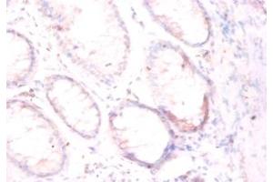 Immunohistochemistry of paraffin-embedded human colorectal carcinoma using FOLH1 / PSMA antibody at dilution of 1:50. (PSMA Antikörper  (Biotin))