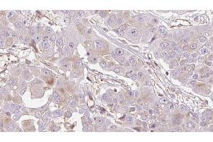 ABIN6272715 at 1/100 staining Human liver cancer tissue by IHC-P. (OR1E2 Antikörper  (C-Term))