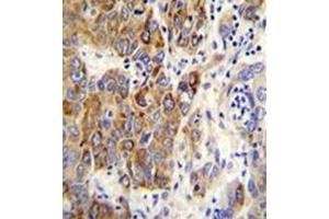 Formalin fixed, paraffin embedded human hepatocarcinoma stained with CYP2B6 Antibody (Center) followed by peroxidase conjugation of the secondary antibody and DAB staining.