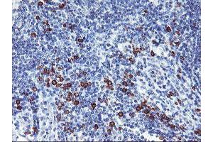 Immunohistochemical staining of paraffin-embedded Human lymphoma tissue using anti-IGJ mouse monoclonal antibody. (IGJ Antikörper)