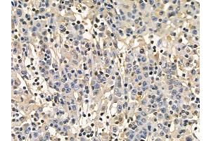 PKM2 Mouse Monoclonal Antibody at 1/100 staining human gastric cancer by IHC-P.