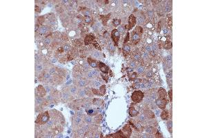 Immunohistochemistry of paraffin-embedded human liver cancer using Cyclin B2 Rabbit mAb (ABIN7266557) at dilution of 1:100 (40x lens). (Cyclin B2 Antikörper)