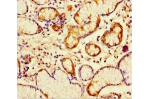 Immunohistochemistry of paraffin-embedded human gastric cancer using ABIN7162782 at dilution of 1:100 (PGLYRP4 Antikörper  (AA 18-317))