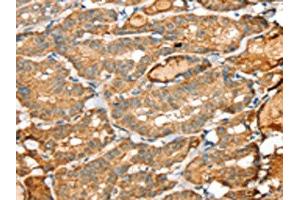 The image on the left is immunohistochemistry of paraffin-embedded Human thyroid cancer tissue using ABIN7192361(SIGLEC14 Antibody) at dilution 1/30, on the right is treated with synthetic peptide. (SIGLEC14 Antikörper)