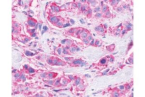 Anti-FFAR3 / GPR41 antibody IHC of human Breast, Carcinoma. (FFAR3 Antikörper  (Internal Region))
