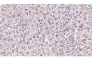ABIN6276805 at 1/100 staining Human melanoma tissue by IHC-P. (Vitronectin Antikörper  (Internal Region))