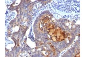 Immunohistochemical staining (Formalin-fixed paraffin-embedded sections) of human colon carcinoma with ECM1 monoclonal antibody, clone ECM1/792 . (ECM1 Antikörper)
