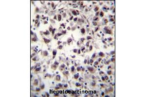 SFRS7 Antibody (N-term) (ABIN656240 and ABIN2845556) immunohistochemistry analysis in formalin fixed and paraffin embedded human hepatocarcinoma tissue followed by peroxidase conjugation of the secondary antibody and DAB staining. (SFRS7 Antikörper  (N-Term))