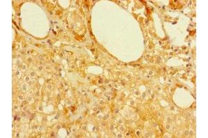 Immunohistochemistry of paraffin-embedded human prostate cancer using ABIN7160129 at dilution of 1:100