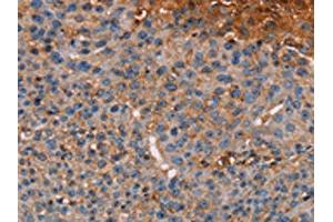 The image on the left is immunohistochemistry of paraffin-embedded Human breast cancer tissue using ABIN7130441(NOC2L Antibody) at dilution 1/20, on the right is treated with fusion protein. (NOC2L Antikörper)