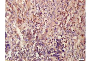 Formalin-fixed and paraffin embedded human lung carcinoma labeled with Anti-Tubulin-Beta Polyclonal Antibody, Unconjugated (ABIN672231) at 1:200 followed by conjugation to the secondary antibody and DAB staining (TUBB3 Antikörper  (AA 31-130))