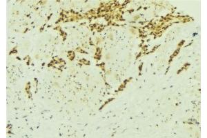ABIN6277137 at 1/100 staining Human breast cancer tissue by IHC-P. (ATF2 Antikörper  (N-Term))