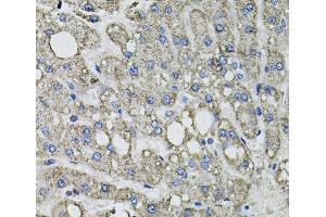 Immunohistochemistry of paraffin-embedded Human liver damage using GFPT1 Polyclonal Antibody at dilution of 1:100 (40x lens). (GFPT1 Antikörper)