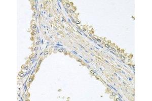 Immunohistochemistry of paraffin-embedded Human prostate using PMM2 Polyclonal Antibody at dilution of 1:100 (40x lens). (PMM2 Antikörper)