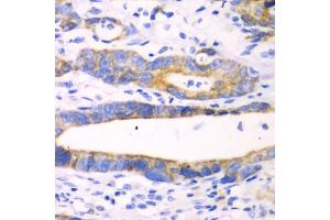 Immunohistochemistry of paraffin-embedded human gastric cancer using CHIA antibody (ABIN5971776) at dilution of 1/100 (40x lens). (CHIA Antikörper)