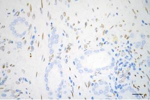 Immunohistochemistry was performed on paraffin-embedded human prostatic adenocarcinoma using fibroblast growth factor 2 antibody (ABIN7798604), 1:200). (Rekombinanter FGF2 Antikörper)